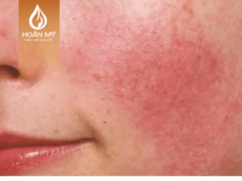 Da nhạy cảm có tình trạng kích ứng đỏ