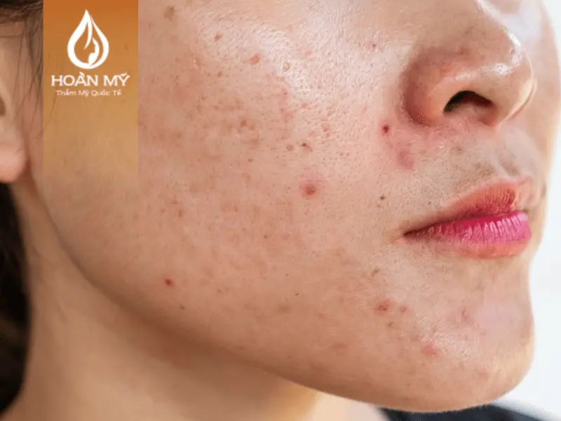 Làn da dầu mụn làm tắc nghẽn lỗ chân lông