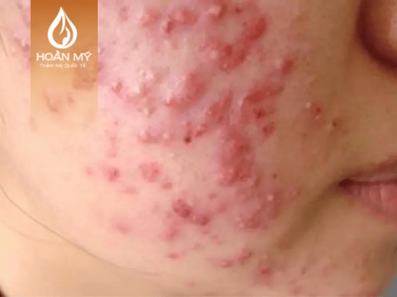 Da bị mụn viêm đỏ không nên sử dụng Meso Ultra không kim