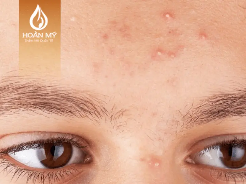 Mụn đầu trắng xuất hiện nằm sâu dưới da và lỗ chân lông bị bịt kín nên có màu trắng với kích thước nhỏ