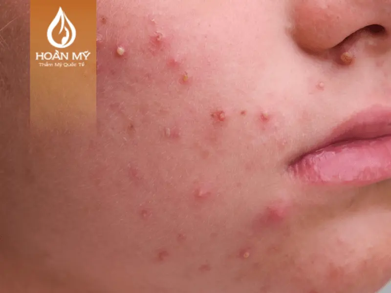 Học cách điều trị mụn đầu trắng tại lớp học chăm sóc da 