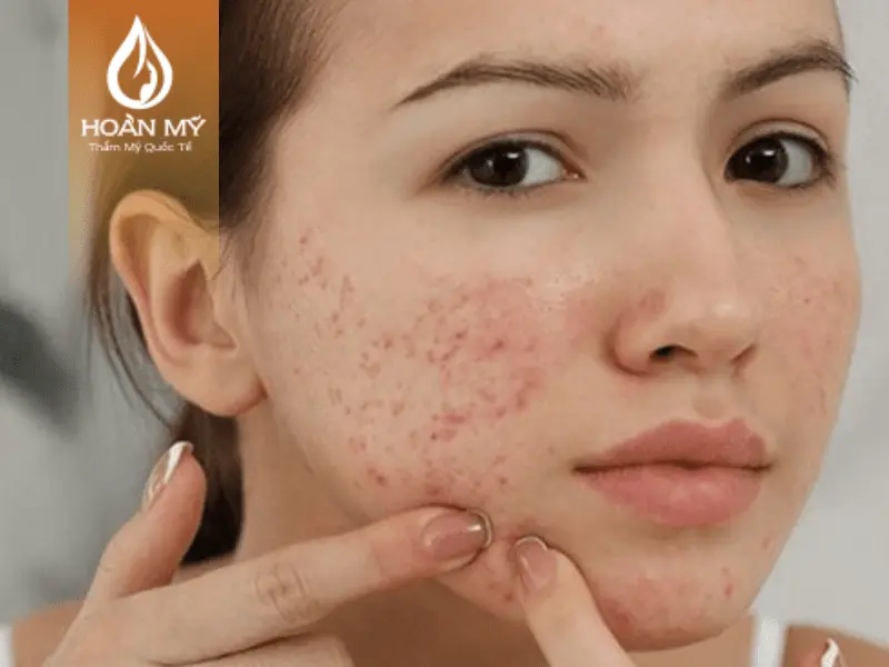 Vi khuẩn ở tay tác động lên mặt có thể khiến tình trạng mụn trở nên xấu đi