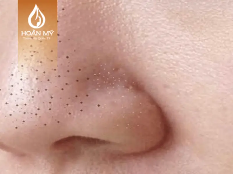     Mụn đầu đen hình thành và xuất hiện chủ yếu ở vùng trán, mũi và cằm