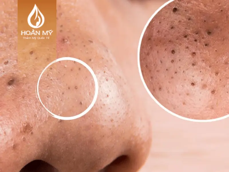 Mụn đầu đen không được loại bỏ sẽ khiến lỗ chân lông trên mặt ngày càng to gây mất thẩm mỹ