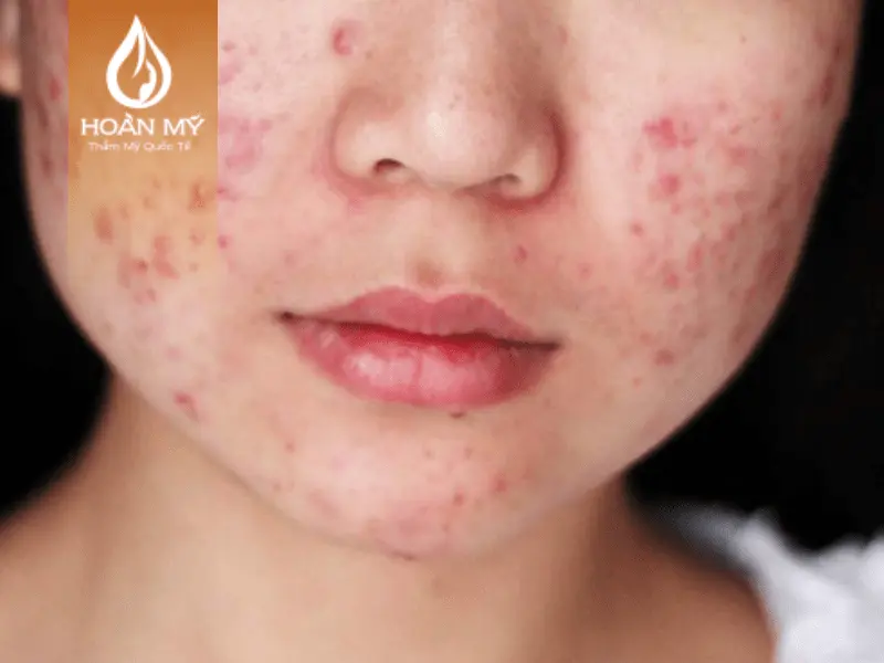 Mụn trứng cá gây viêm đỏ làn da và gây đau rát