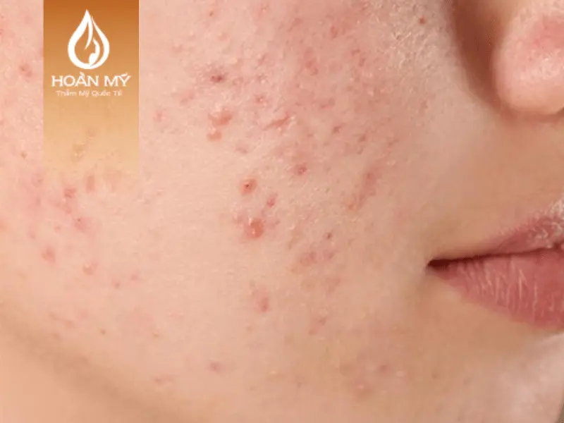 Mụn trứng cá có thể dẫn đến sẹo nếu không được điều trị đúng cách.