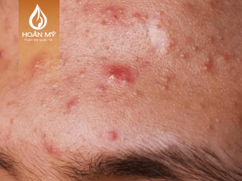 Mụn viêm xuất hiện nhiều trên mặt và trán