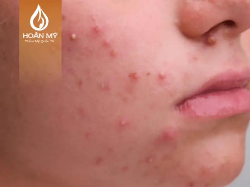 Trường hợp mụn viêm nhẹ như mụn sần hoặc mụn mủ nhỏ có khả năng tự hết