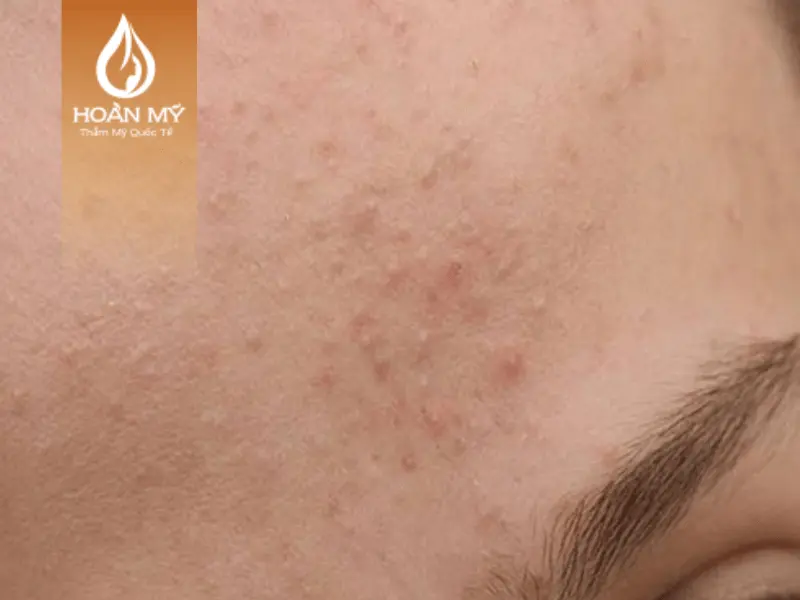 Mụn ẩn nằm sâu trong làn da và khó nhìn thấy bằng mắt thường