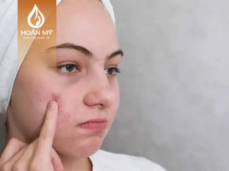 Hormone thay đổi cũng sẽ dễ khiến mụn xuất hiện và sản sinh