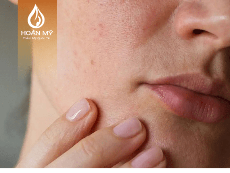 Tránh gãi hoặc chà sát mạnh trên làn da để tránh viêm nhiễm