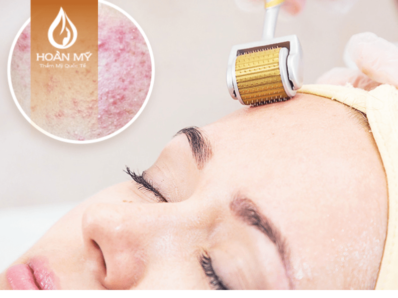 Liệu pháp giúp làm giảm mụn trên làn da