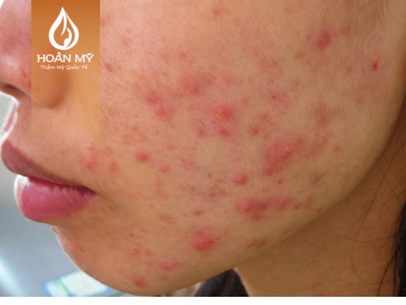 Da liễu bị viêm nghiêm trọng không nên sử dụng phương pháp lăn kim