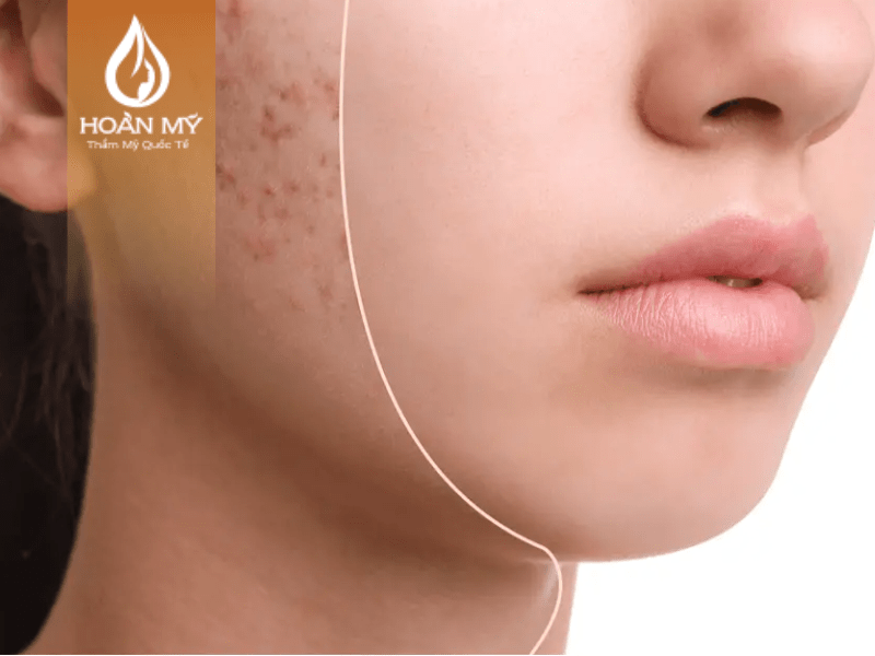 Hỗ trợ điều trị mụn, thâm, nám trên làn da