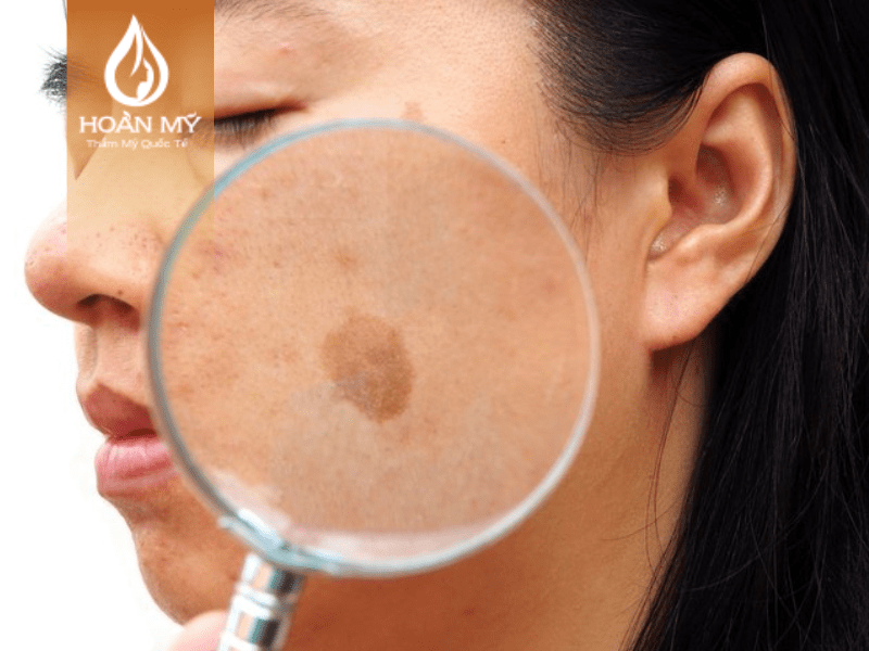 Bước sóng 730 nm trong việc điều trị xóa đồi mồi trên da