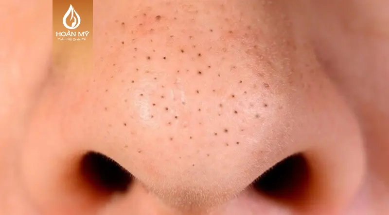 Mụn đầu đen hình thành do lỗ chân lông tích tụ vi khuẩn, bụi bẩn trong thời gian dài