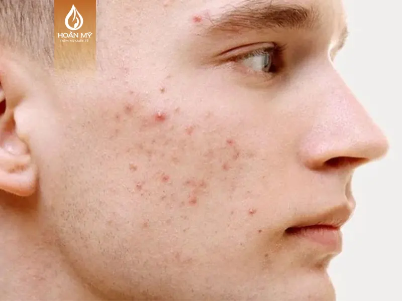 Biểu hiện của mụn trứng cá trên da