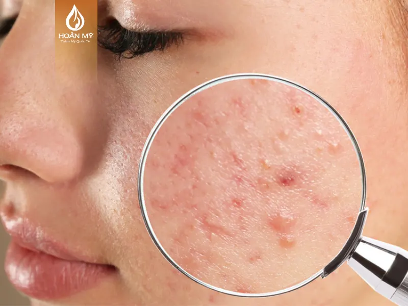 Mụn viêm sưng đỏ gây đau nhức khiến nhiều người mất tự tin