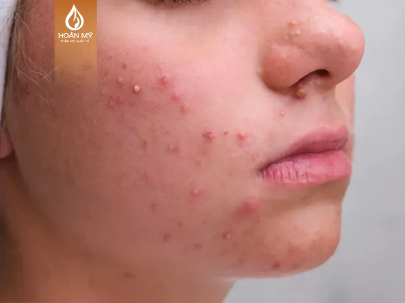 Nắm rõ cách điều trị mụn trứng cá để trở thành chuyên gia chăm sóc da