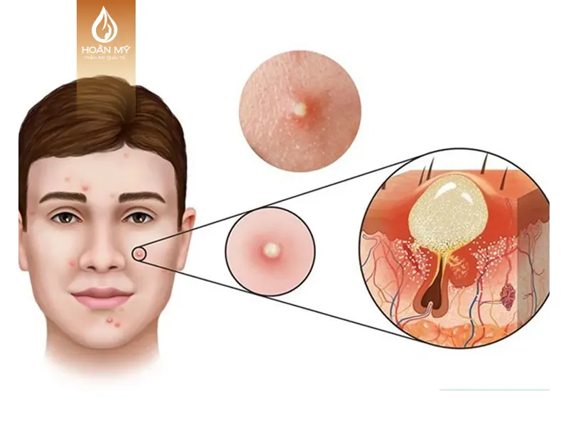 Hình ảnh các nốt mụn viêm xuất hiện trên bề mặt da