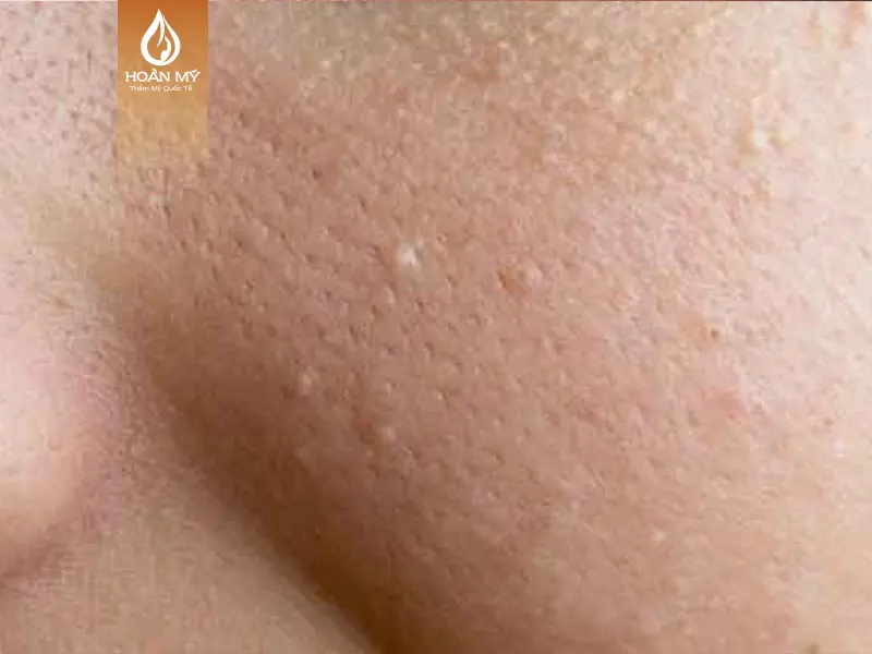 Hình ảnh mô tả mụn đầu trắng bên trong da