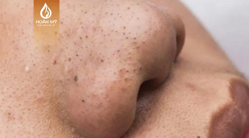 Mụn đầu đen xuất phát từ nhiều nguyên nhân khác nhau và tùy vào cơ địa của từng ngườiMụn đầu đen xuất phát từ nhiều nguyên nhân khác nhau và tùy vào cơ địa của từng người