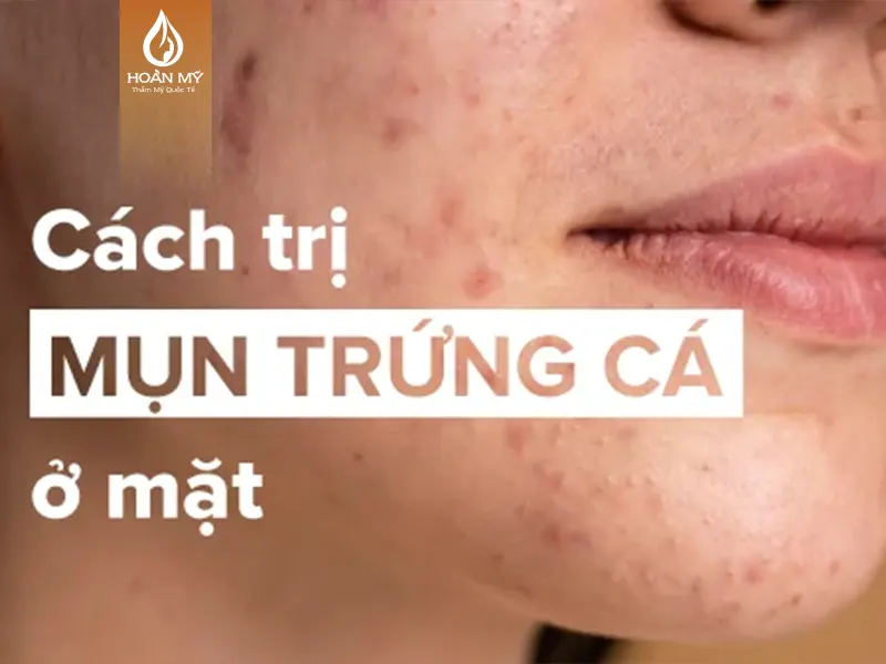 Cách trị mụn trứng cá ở mặt