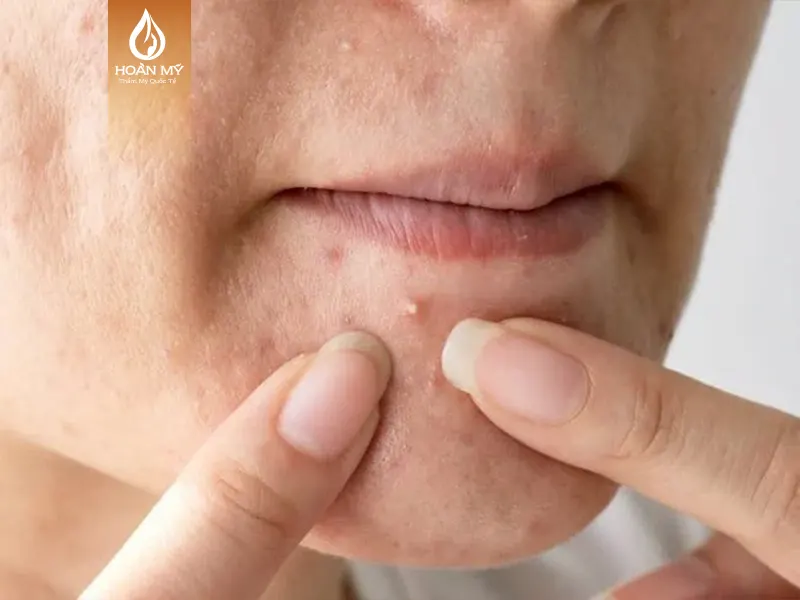 Đối tượng dễ mắc phải mụn đầu trắng