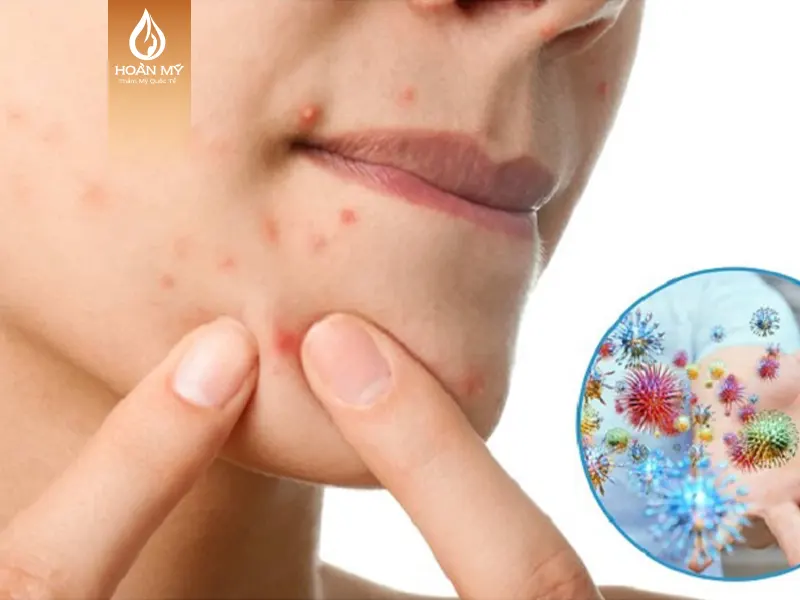 Để điều trị mụn đầu trắng hiệu quả cần nắm rõ các nguyên nhân và đối tượng mắc phải