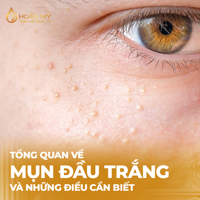Tổng quan về mụn đầu trắng và những điều cần biết