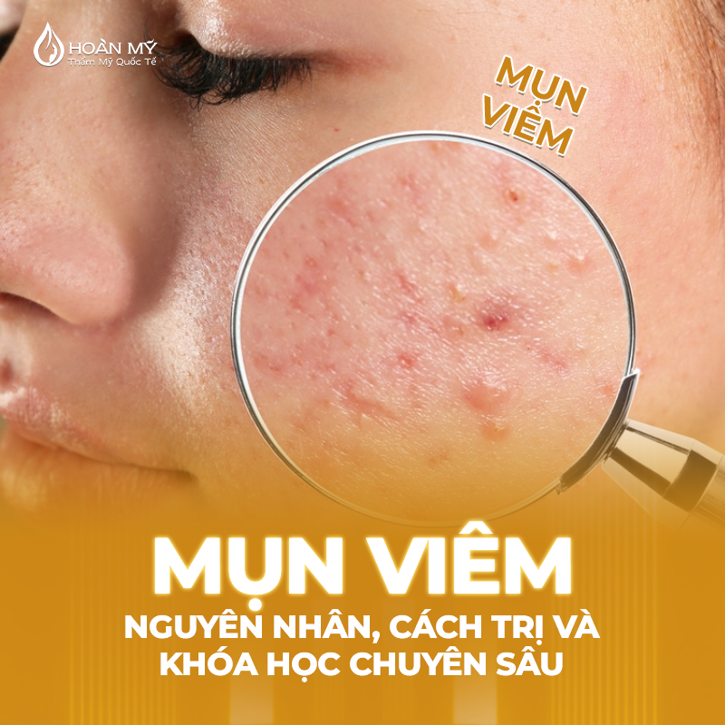 Khóa đào tạo chăm sóc da: Tất tầng tật về Mụn viêm