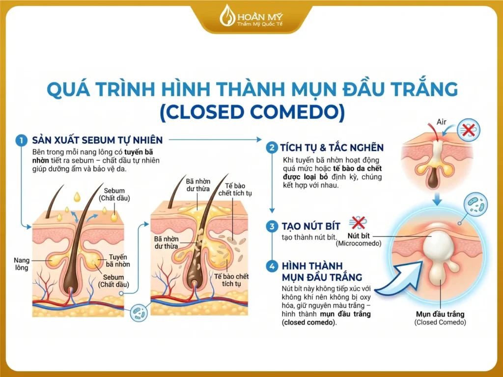 quá trình hình thành mụn đầu trắng
