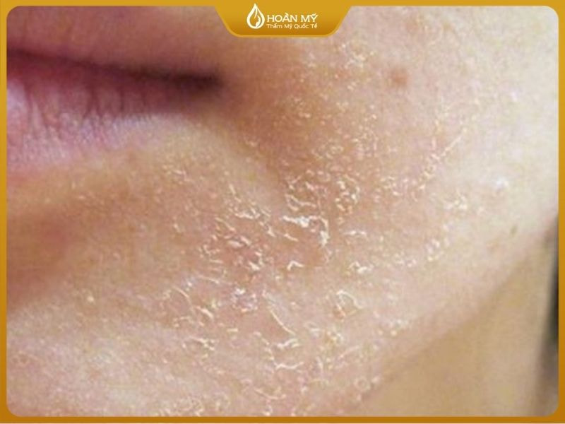 Da khô thường dễ bong tróc do thiếu nước