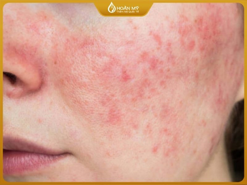 Da nhạy cảm là làn da dễ bị kích ứng bởi mỹ phẩm, môi trường, thời tiết