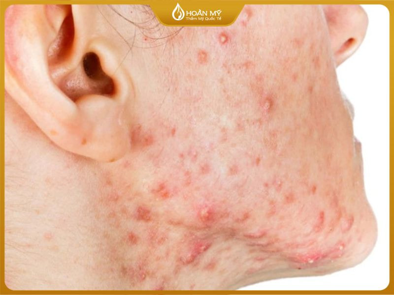 Không nên lấy mụn khi da đang viêm nặng