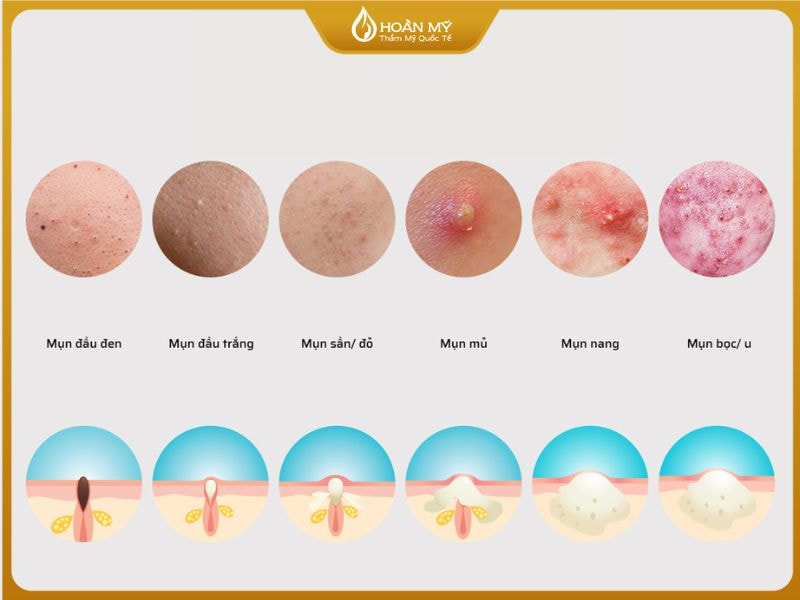 Việc phân biệt đúng loại mụn là bước nền tảng quan trọng trong khóa học chăm sóc da mặt cơ bản