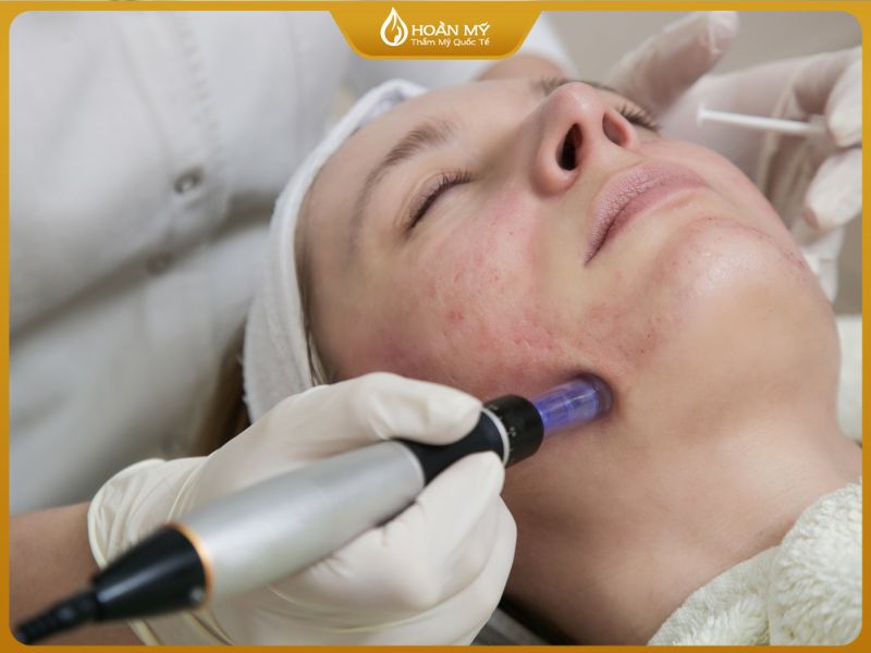 Chăm sóc da sau vi kim sinh học đúng cách giúp da phục hồi khỏe mạnh