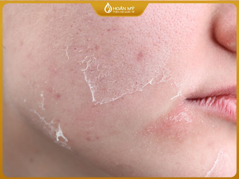 Dấu hiệu da bong tróc sau vi kim sinh học là phản ứng bình thường