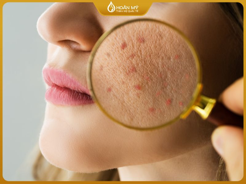 Học viên phân biệt các loại mụn trong khóa học điều trị mụn