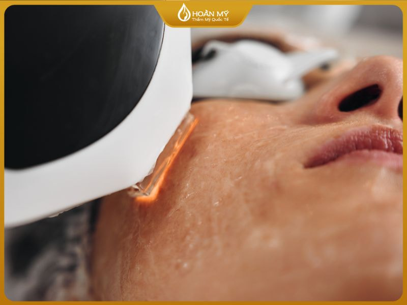 Khóa học điều trị mụn tại Hoàn Mỹ tích hợp công nghệ như đèn sinh học, điện di lạnh giúp nâng cao hiệu quả điều trị.