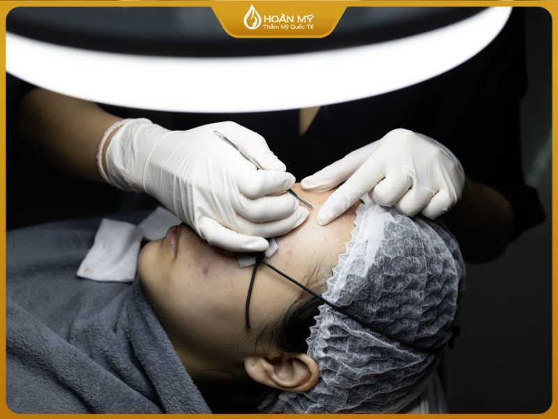 Thực hành kỹ thuật hút mụn sau học chăm sóc da bài 1