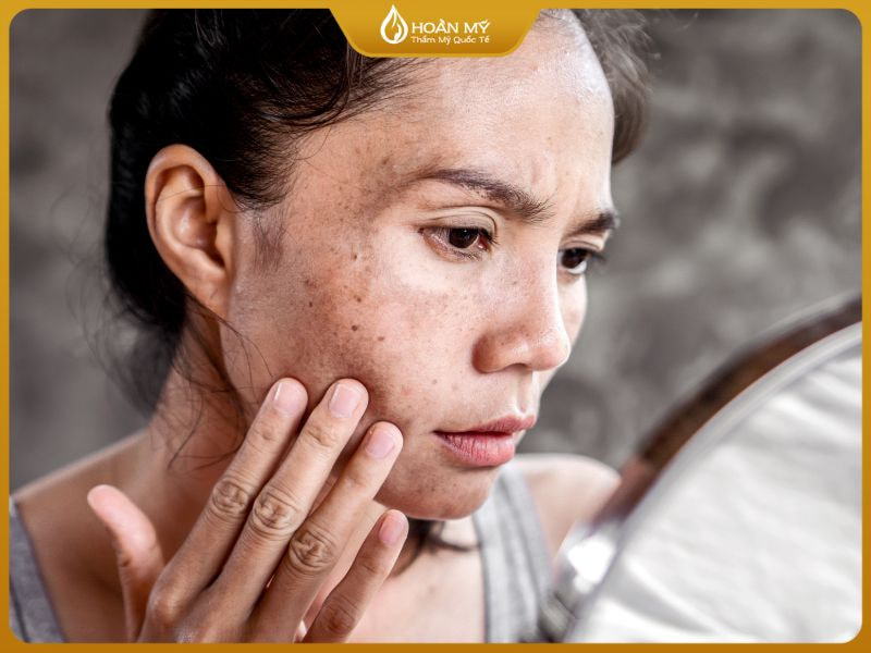 Tình trạng da sạm màu, khô sần là biểu hiện của hàng rào bảo vệ da bị tổn thương – nội dung được đào sâu trong khóa học spa chăm sóc da.